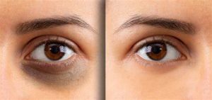 how to get rid of dark circles under eyes
